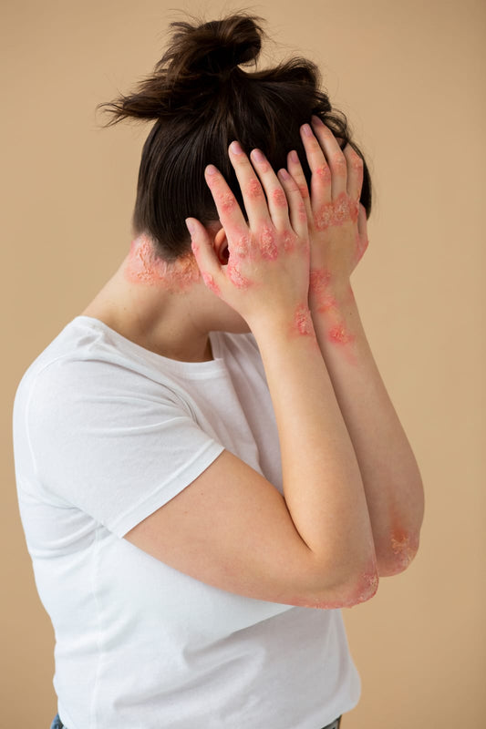 How to get rid of Psoriasis?
