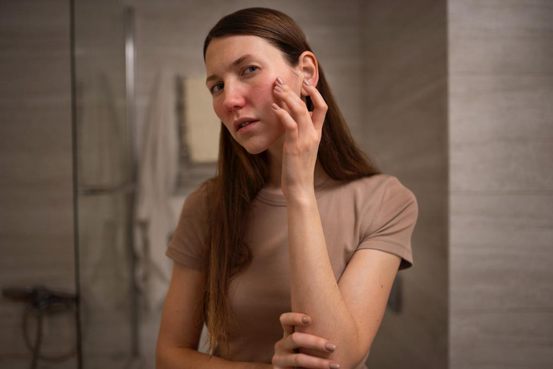 How to cure PCOS Acne Naturally?
