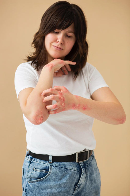 Is Psoriasis Contagious? Dispelling Myths