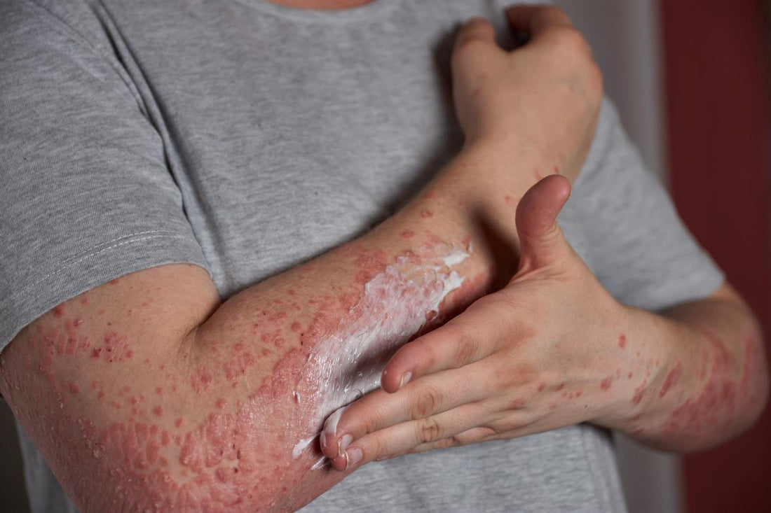 Is There a Cure to Psoriasis?