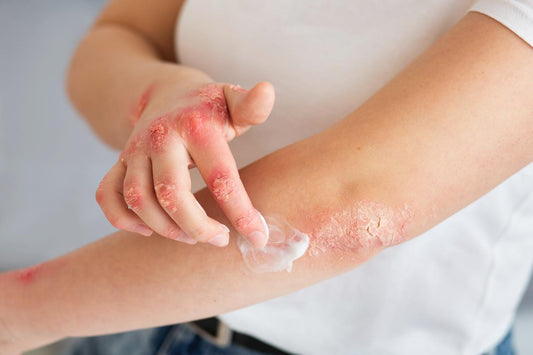 Psoriasis Diet: Foods to Include and Avoid