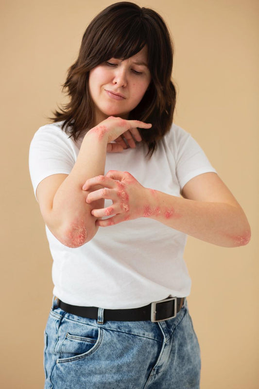Psoriasis Treatments: Overview and Options