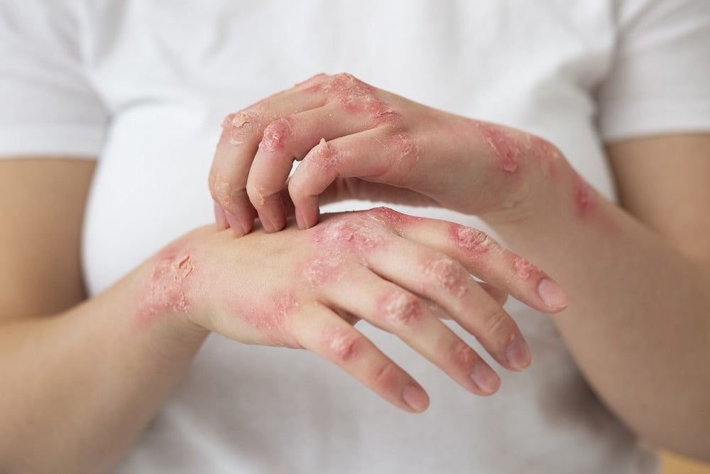 How do you cure Eczema?